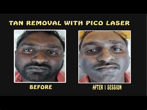 laser tanning removal